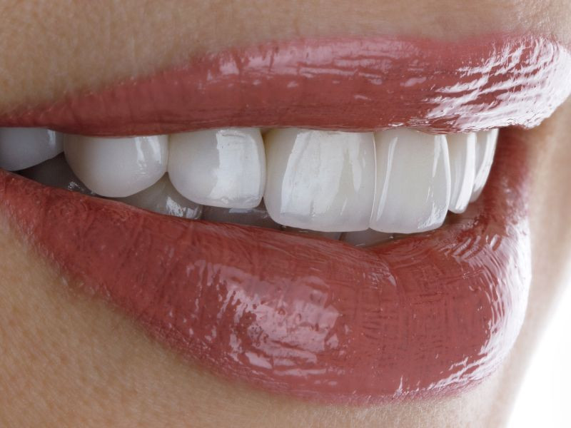 Facetas Dentárias vs Facetas de Resina: Qual é a Melhor Opção para o Seu Sorriso?