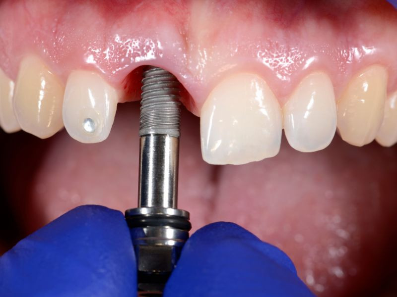 Implantes Dentários: A Solução Ideal para Recuperar o Seu Sorriso