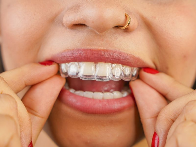 Alinhadores ou Aparelho Fixo: Qual Escolher Para Corrigir o Sorriso?