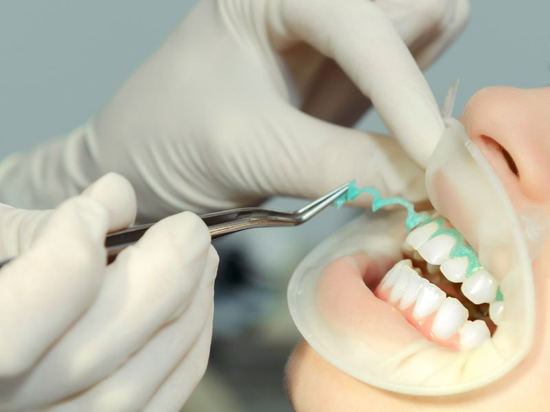 Branqueamento Dentário: Como Conseguir um Sorriso Mais Branco em Segurança?