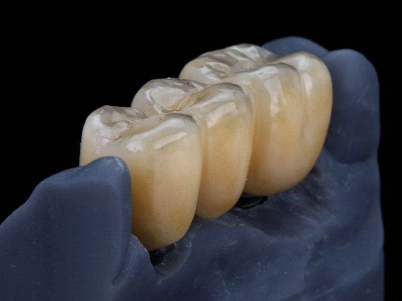 Coroas Cerâmicas: O Segredo para um Sorriso Natural e Resistente