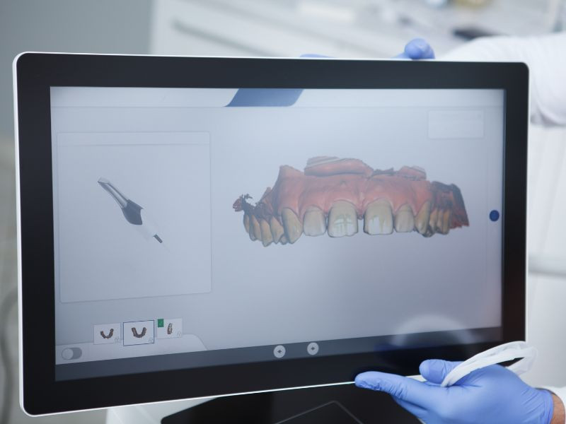 Como Funciona o Scanner Intraoral? Conheça a Tecnologia por Trás do Planeamento Digital
