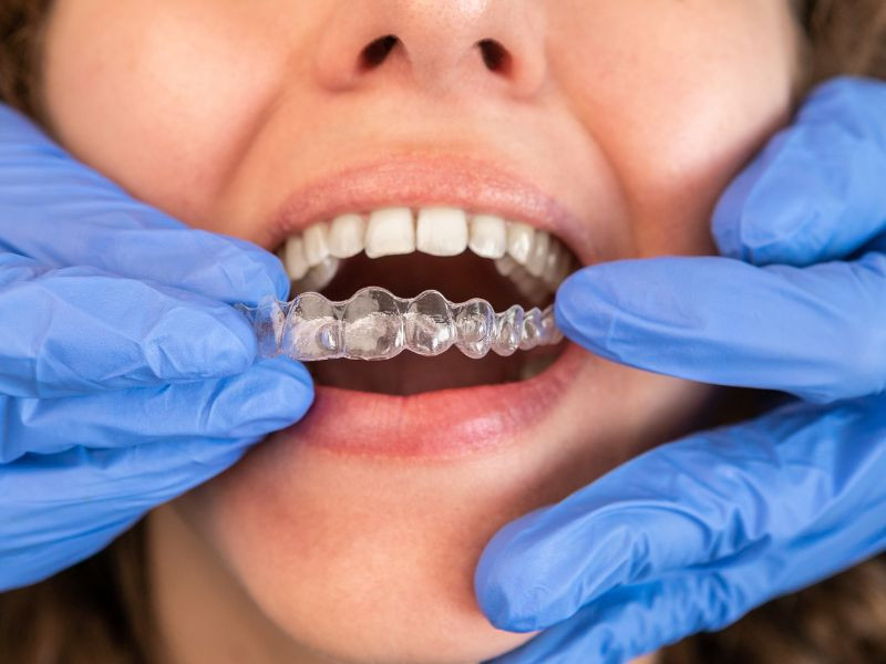 Alinhadores para Adultos: Nunca é Tarde Para Corrigir o Sorriso?