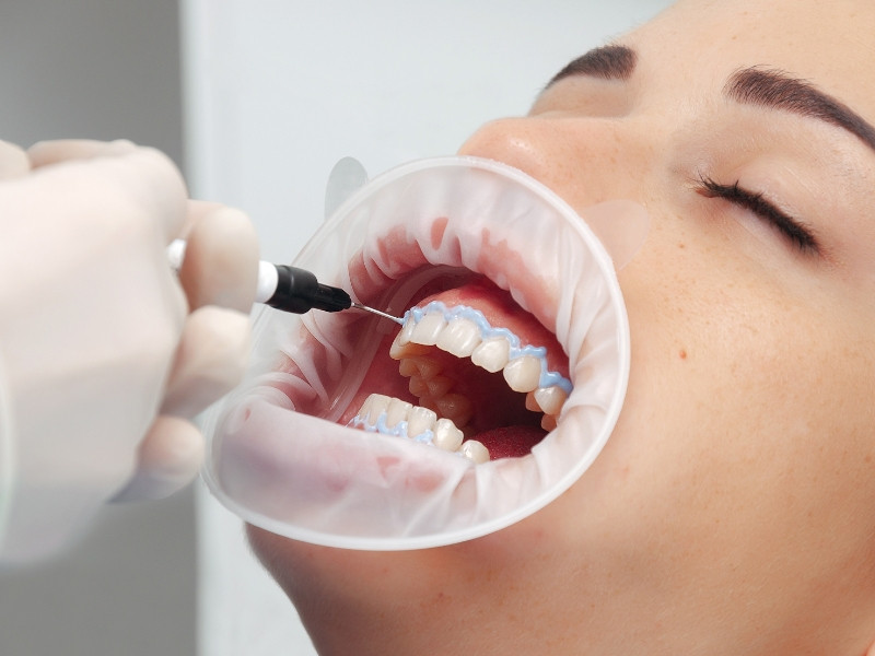 Tratamento de Branqueamento Dentário