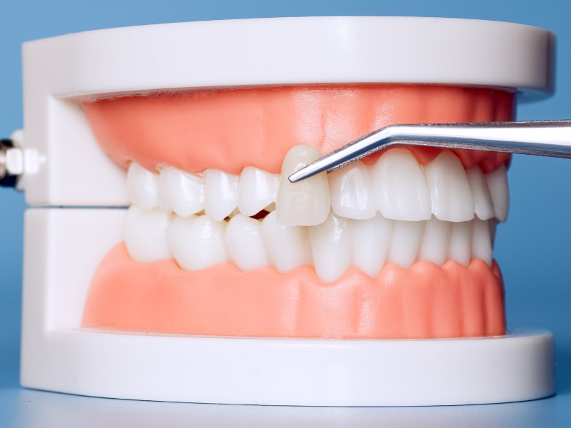 Facetas Dentárias