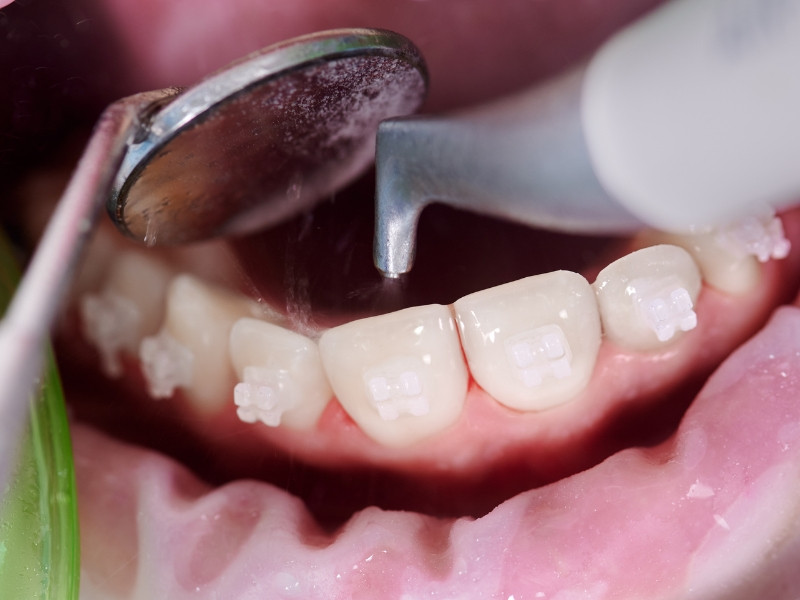 Consulta de Medicina Dentária para Destartarização e Jato de Bicarbonato