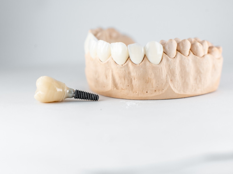 Tratamento de Próteses Sobre Implantes