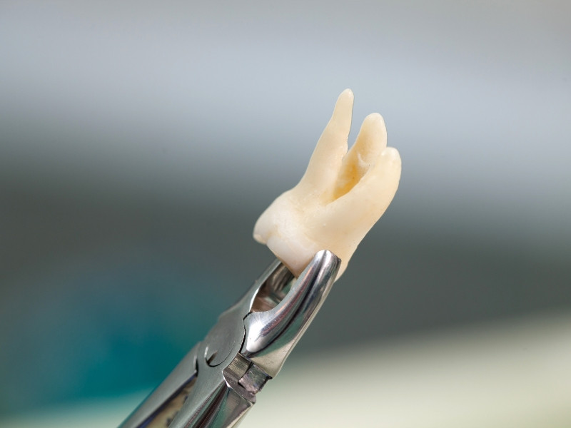 Tratamento de Extrações de Dentes