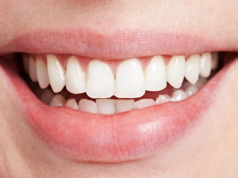 Tratamento para Alteração de Cor do Dente